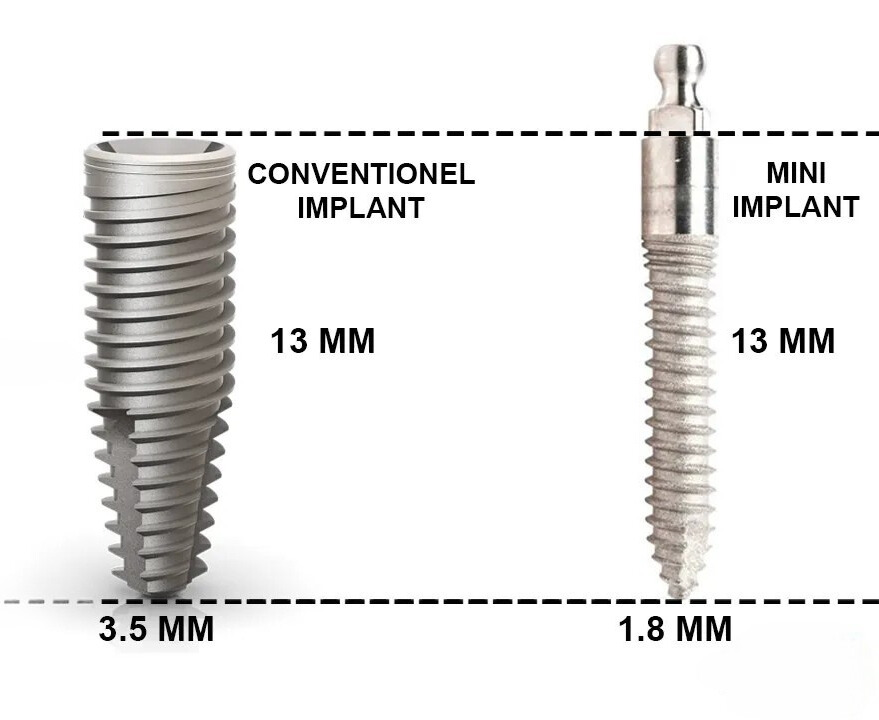 dental implant mini vs conventional